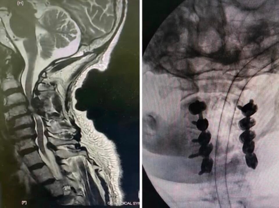 5 ساعات.. "الملك سلمان الطبية" تنهي شللًا رباعيًا لسبعيني